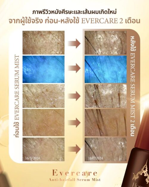 Evercare Hair Farm Serum, a valuable extract for women with hair loss